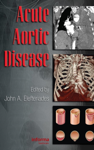 Acute Aortic Disease, Hardback Book