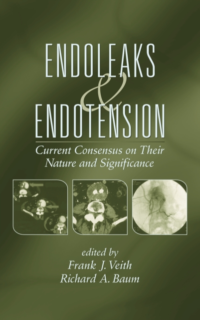 Endoleaks and Endotension : Current Consensus on Their Nature and Significance, PDF eBook
