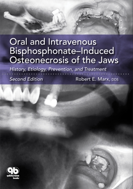 Oral and Intravenous Bisphosphonate-Induced Osteonecrosis of the Jaws : History, Etiology, Prevention, and Treatment, Second Edition, EPUB eBook