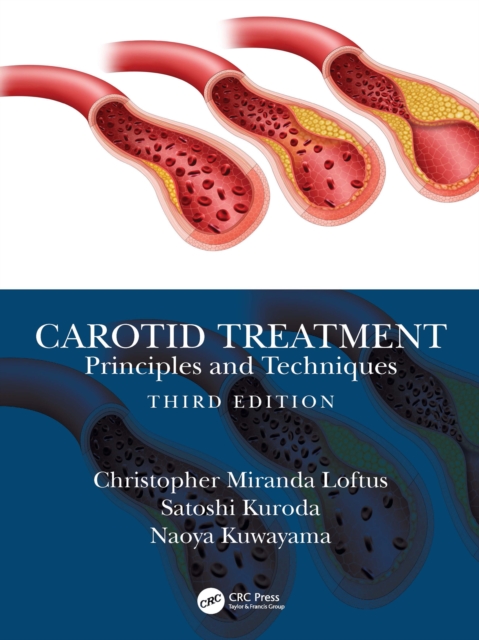 Carotid Treatment: Principles and Techniques, PDF eBook
