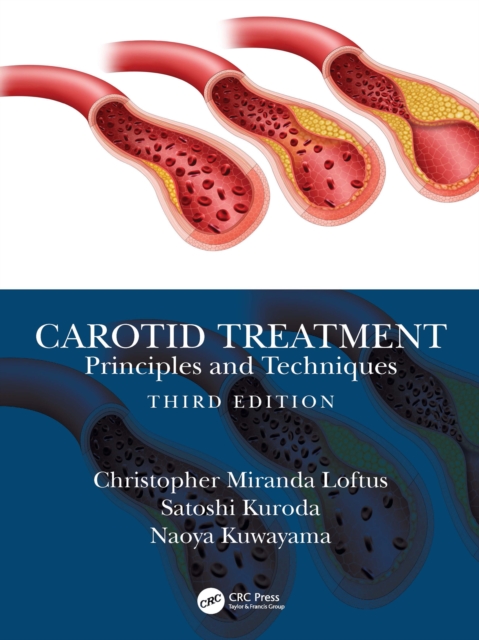 Carotid Treatment: Principles and Techniques, EPUB eBook