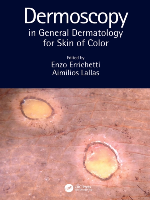 Dermoscopy in General Dermatology for Skin of Color, PDF eBook
