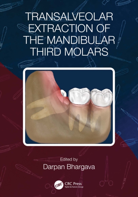 Transalveolar Extraction of the Mandibular Third Molars, EPUB eBook