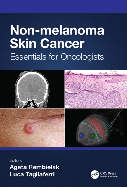 Non-melanoma Skin Cancer : Essentials for Oncologists, EPUB eBook