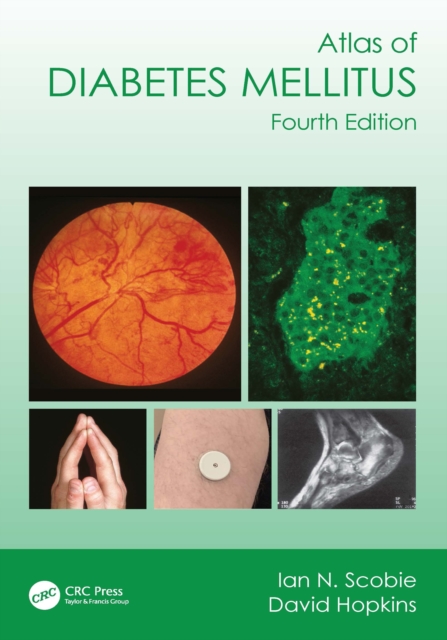 Atlas of Diabetes Mellitus, PDF eBook
