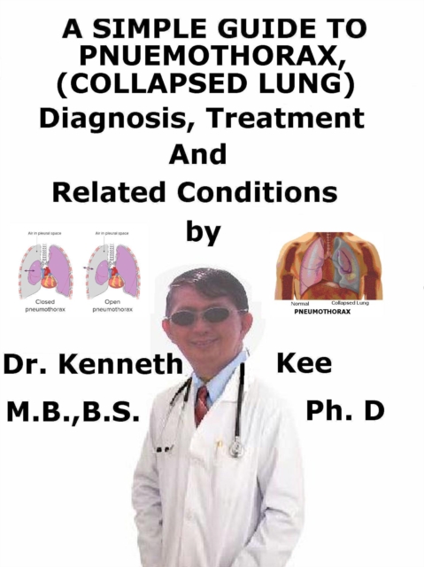Simple Guide to Pneumothorax (Collapsed Lungs), Diagnosis, Treatment and Related Conditions, EPUB eBook
