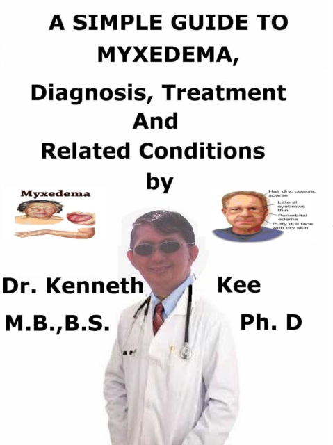 Simple Guide to Myxedema, Diagnosis, Treatment and Related Conditions, EPUB eBook