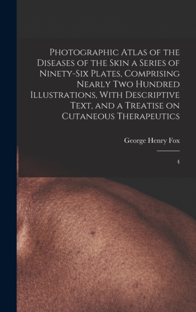 Photographic Atlas of the Diseases of the Skin a Series of Ninety-six Plates, Comprising Nearly two Hundred Illustrations, With Descriptive Text, and a Treatise on Cutaneous Therapeutics : 4, Hardback Book