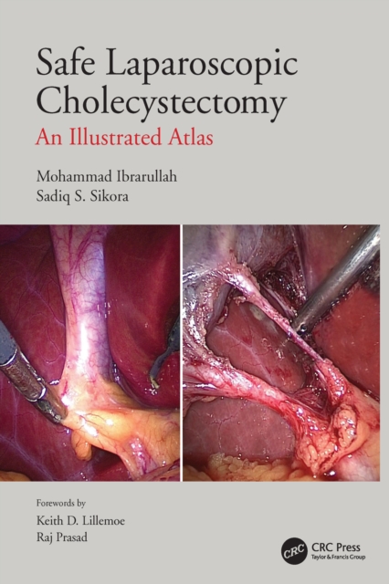 Safe Laparoscopic Cholecystectomy : An Illustrated Atlas, Paperback / softback Book