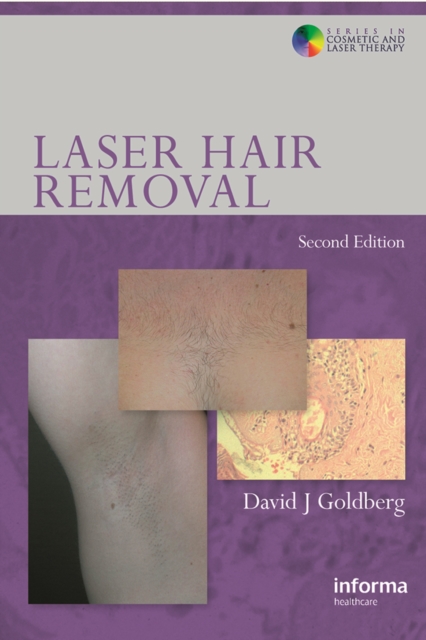 Laser Hair Removal, EPUB eBook
