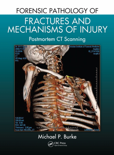 Forensic Pathology of Fractures and Mechanisms of Injury : Postmortem CT Scanning, EPUB eBook