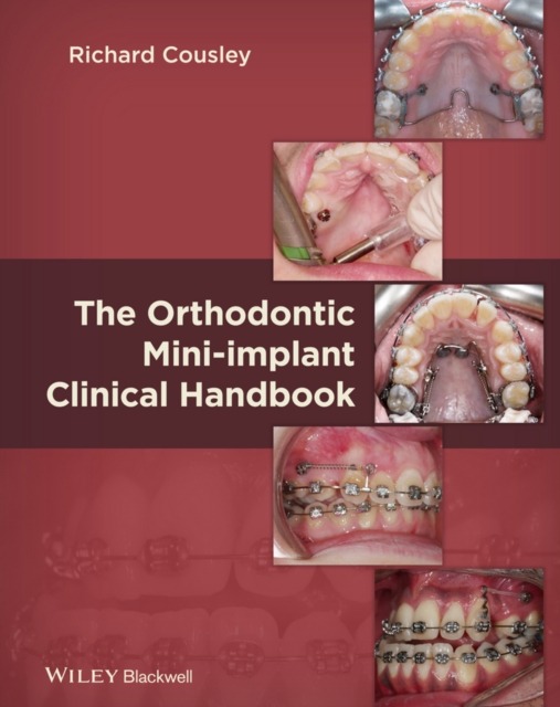 The Orthodontic Mini-implant Clinical Handbook, PDF eBook