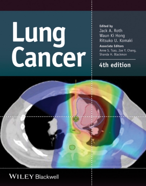 Lung Cancer, Hardback Book