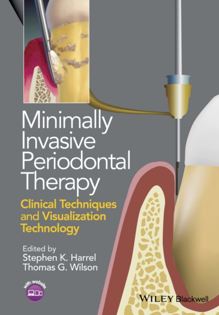 Minimally Invasive Periodontal Therapy : Clinical Techniques and Visualization Technology, Paperback / softback Book