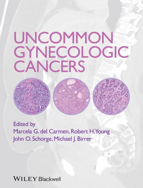 Uncommon Gynecologic Cancers, EPUB eBook