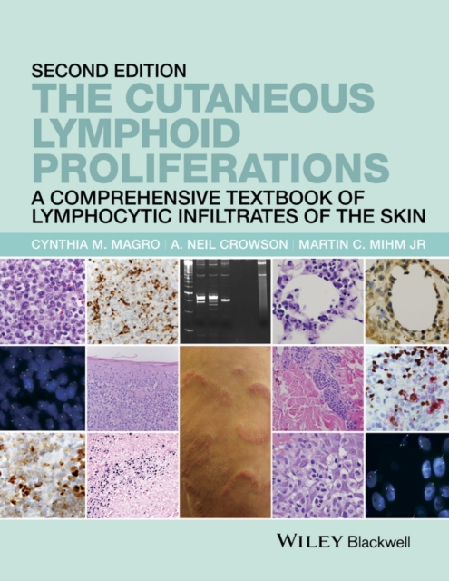 The Cutaneous Lymphoid Proliferations : A Comprehensive Textbook of Lymphocytic Infiltrates of the Skin, Hardback Book