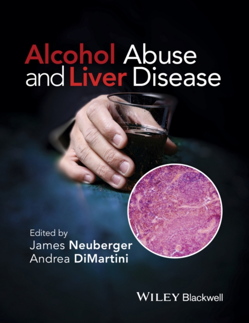 Alcohol Abuse and Liver Disease, Hardback Book