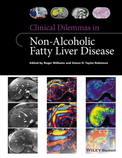 Clinical Dilemmas in Non-Alcoholic Fatty Liver Disease, Paperback / softback Book