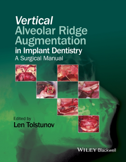 Vertical Alveolar Ridge Augmentation in Implant Dentistry - A Surgical Manual, Hardback Book