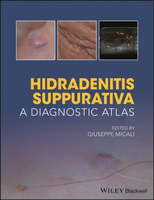 Hidradenitis Suppurativa : A Diagnostic Atlas, PDF eBook
