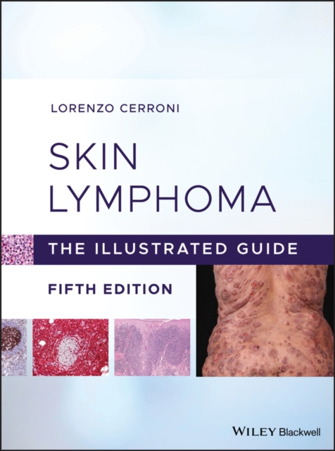 Skin Lymphoma : The Illustrated Guide, Hardback Book