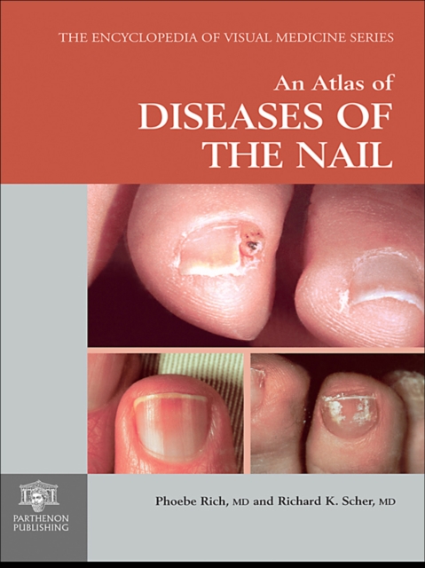 An Atlas of Diseases of the Nail, PDF eBook