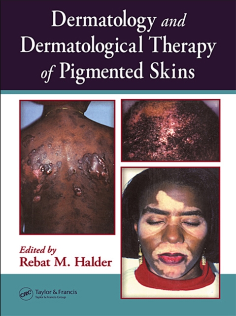 Dermatology and Dermatological Therapy of Pigmented Skins, PDF eBook