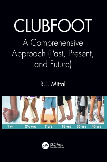 Clubfoot : A Comprehensive Approach (Past, Present, and Future), Hardback Book
