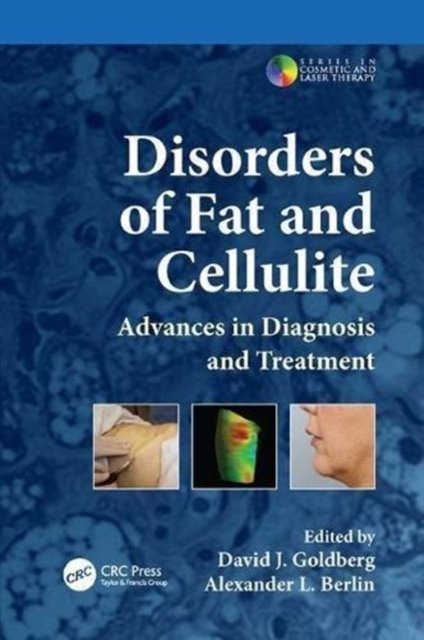 Disorders of Fat and Cellulite : Advances in Diagnosis and Treatment, Paperback / softback Book