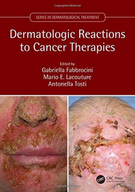 Dermatologic Reactions to Cancer Therapies, Hardback Book