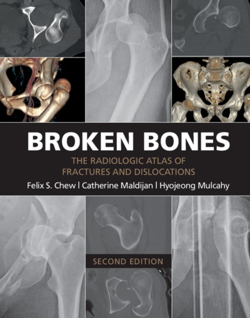 Broken Bones : The Radiologic Atlas of Fractures and Dislocations, EPUB eBook