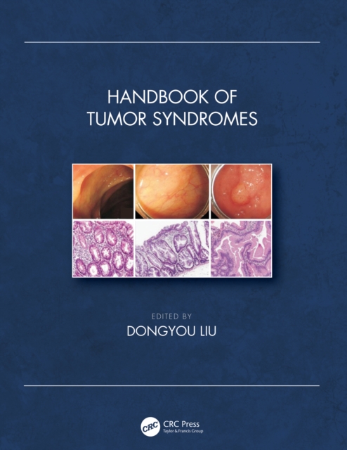 Handbook of Tumor Syndromes, PDF eBook