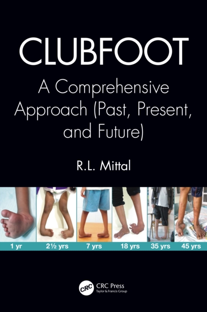 Clubfoot : A Comprehensive Approach (Past, Present, and Future), EPUB eBook