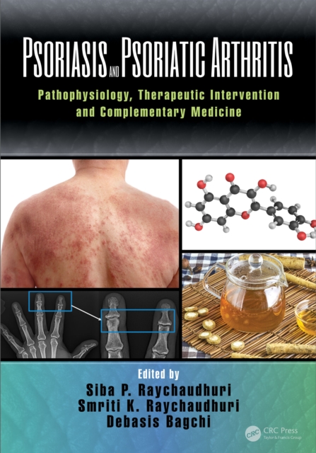 Psoriasis and Psoriatic Arthritis : Pathophysiology, Therapeutic Intervention, and Complementary Medicine, EPUB eBook