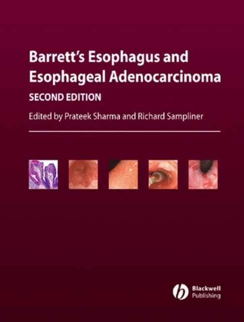 Barrett's Esophagus and Esophageal Adenocarcinoma, Hardback Book