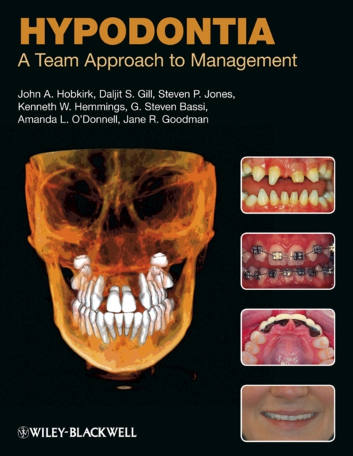Hypodontia : A Team Approach to Management, Hardback Book