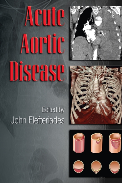 Acute Aortic Disease, PDF eBook