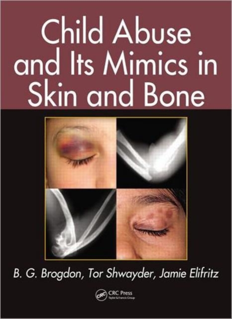 Child Abuse and its Mimics in Skin and Bone, Hardback Book