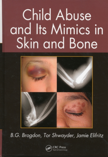 Child Abuse and its Mimics in Skin and Bone, PDF eBook