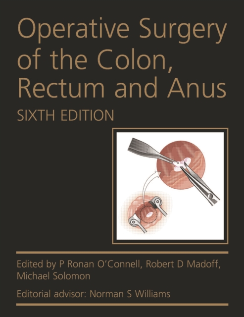 Operative Surgery of the Colon, Rectum and Anus, PDF eBook