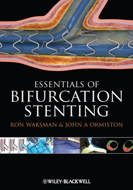 Bifurcation Stenting, EPUB eBook