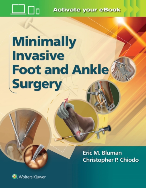 Minimally Invasive Foot & Ankle Surgery, Hardback Book