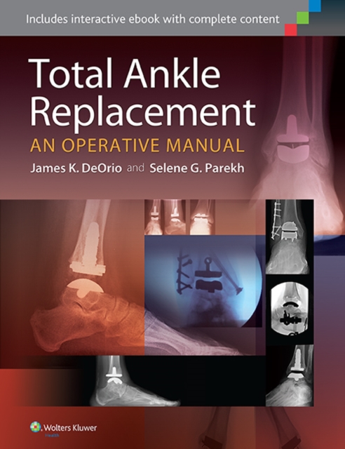 Total Ankle Replacement:  An Operative Manual, Hardback Book