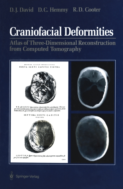 Craniofacial Deformities : Atlas of Three-Dimensional Reconstruction from Computed Tomography, PDF eBook
