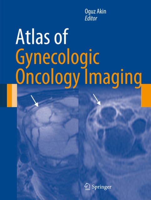 Atlas of Gynecologic Oncology Imaging, PDF eBook