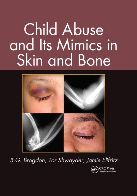 Child Abuse and its Mimics in Skin and Bone, EPUB eBook
