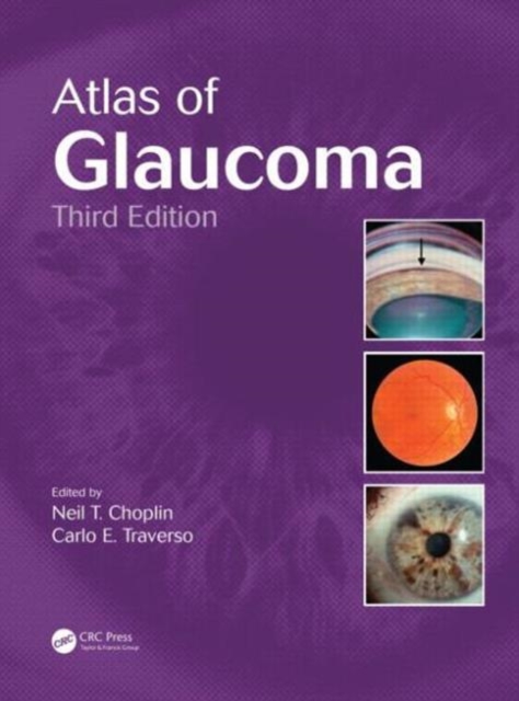 Atlas of Glaucoma, Hardback Book