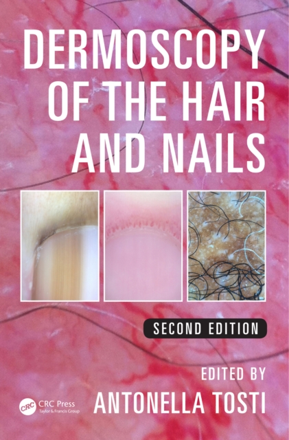 Dermoscopy of the Hair and Nails, PDF eBook