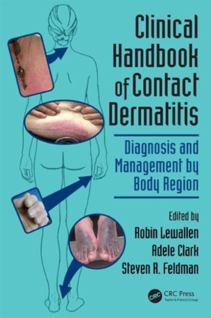 Clinical Handbook of Contact Dermatitis : Diagnosis and Management by Body Region, Paperback / softback Book