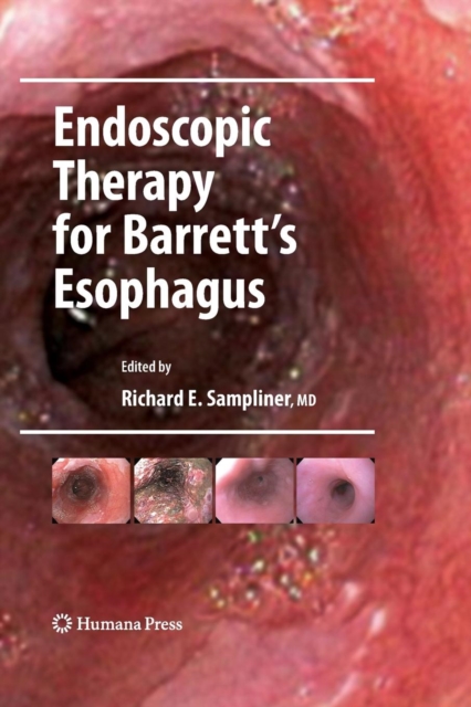 Endoscopic Therapy for Barrett's Esophagus, Paperback / softback Book